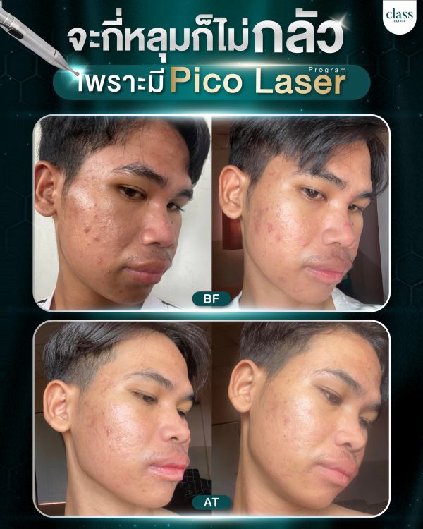 เลเซอร์ | รอยดำ รอยแดง ฟ้า กระ | Class Clinic (กังสดาล/หอกาญ) - Image 4