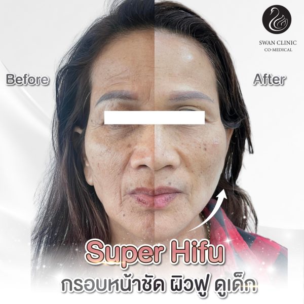 ยกกระชับปรับรูปหน้า | ULTRA SMAS LYFT | SWAN CLINIC (กังสดาล) - Image 2