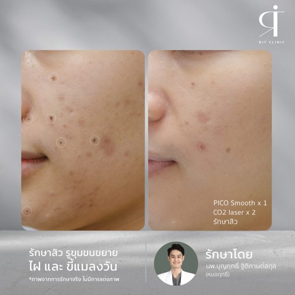 เลเซอร์ รอยสิว ฝ้า กระตื้น ริมฝีปากหมองคล้ำ หลุมสิว | Discovery Pico Laser | RIT CLINIC (กังสดาล) - Image 2