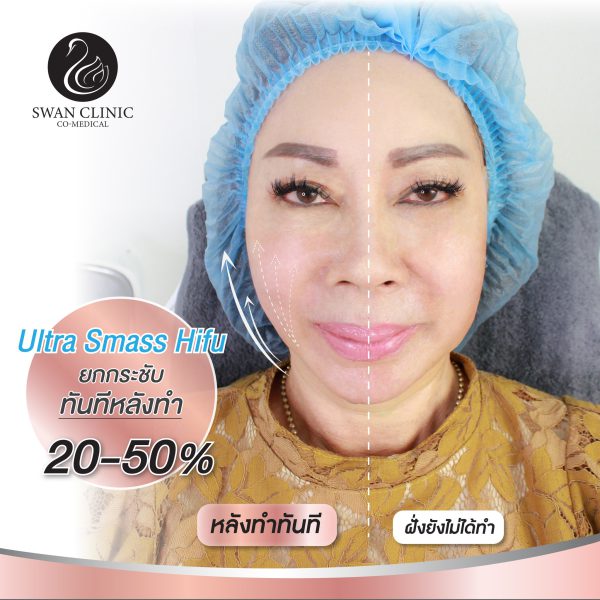 ยกกระชับปรับรูปหน้า | ULTRA SMAS LYFT | SWAN CLINIC (กังสดาล) - Image 3