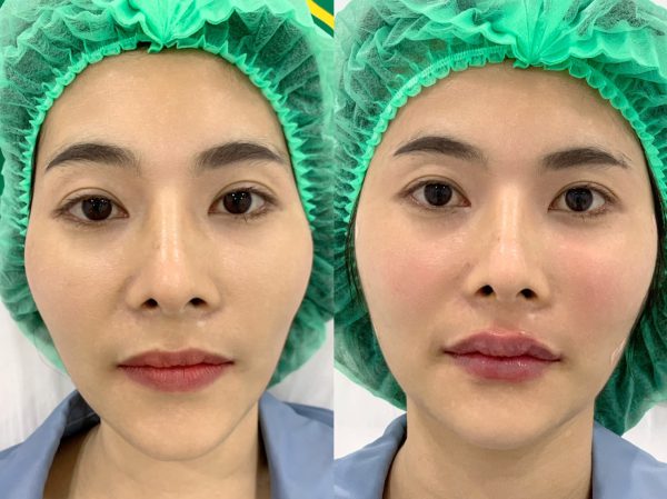 ฟิลเลอร์ | Volifil | Class Clinic (กังสดาล/หอกาญ) - Image 2