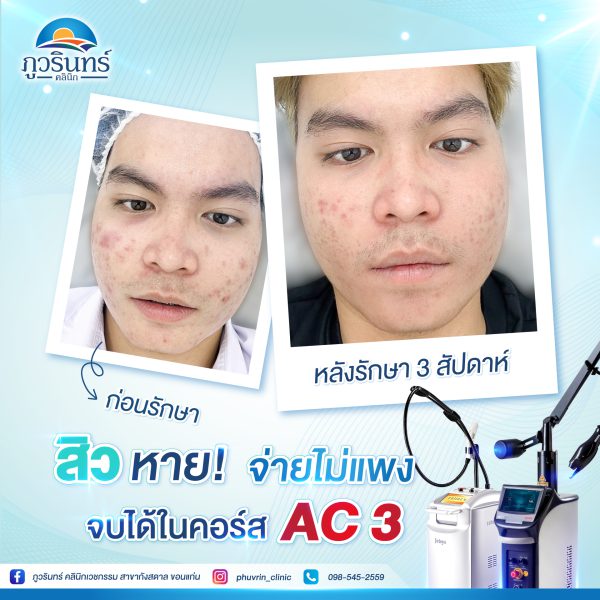 รักษาสิว | ภูวรินทร์คลินิกเวชกรรม (กังสดาล)