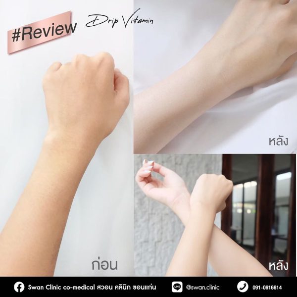ดริปวิตามินผิว | IV-Drip | Swan Clinic (กังสดาล) - Image 4