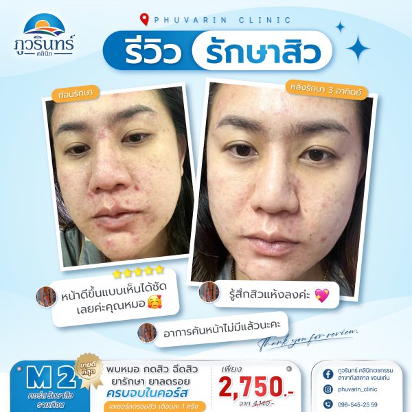 รักษาสิวแบบรายเดือน คอร์ส M2 | ภูวรินทร์คลินิกเวชกรรม (กังสดาล) - Image 2