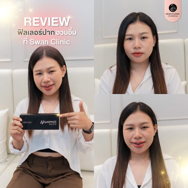 ฟิลเลอร์ | Neuramis | SWAN CLINIC (กังสดาล) - Image 3