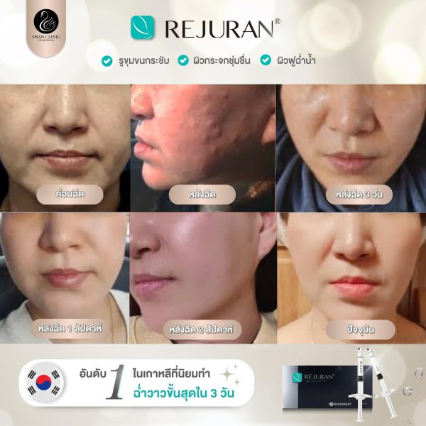 รีจูรัน | Rejuraan | SWAN CLINIC (กังสดาล) - Image 2